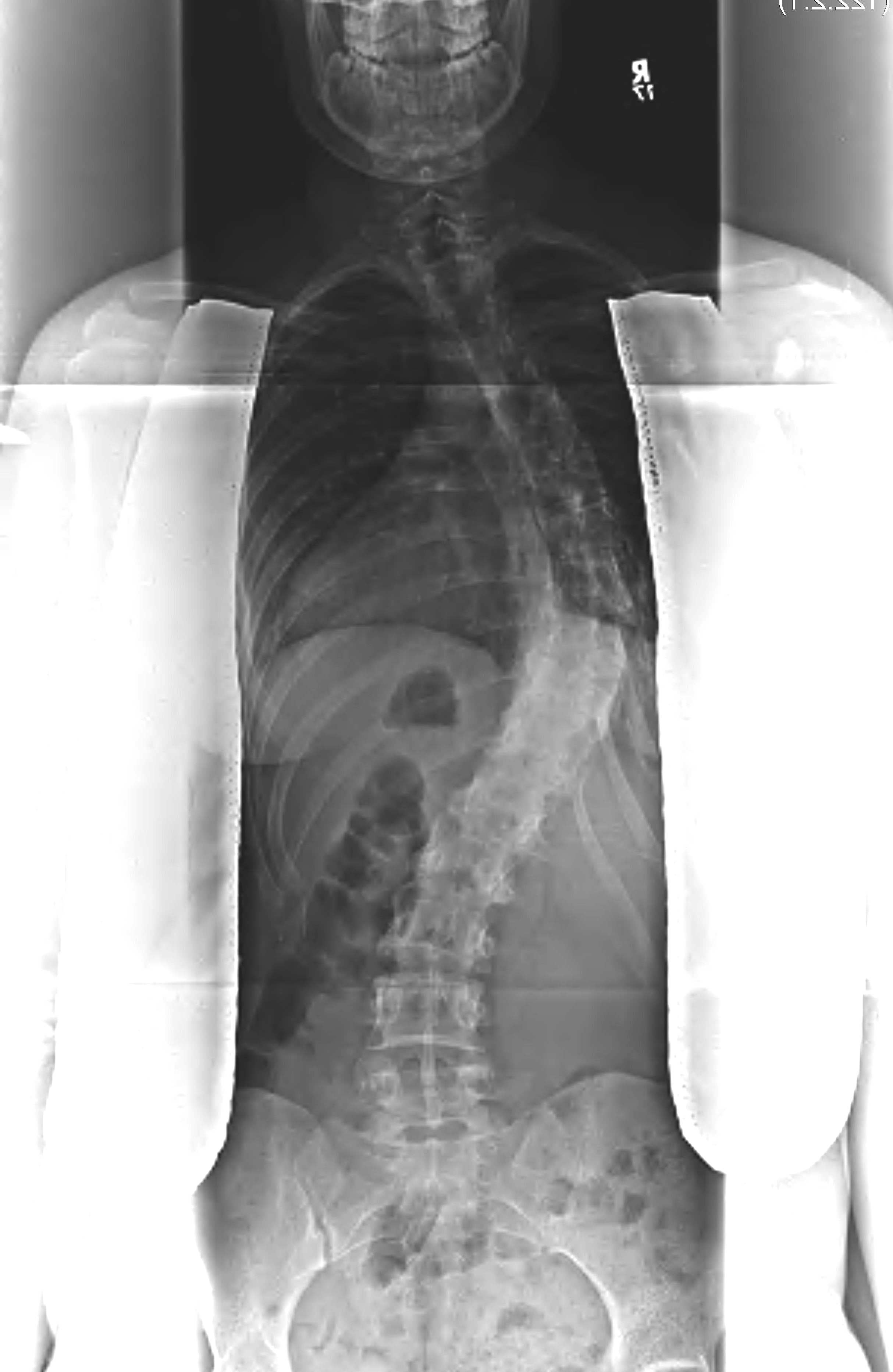Scoliosis Thoracic Major